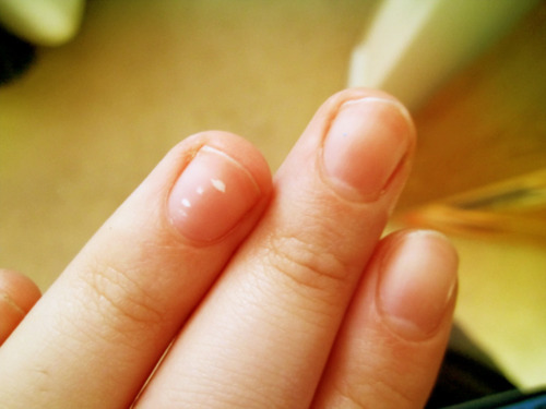 Nails Illness